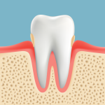 高齢者の歯周病　歯肉炎