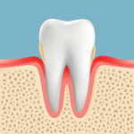 高齢者の歯周病　軽度歯周病