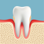 高齢者の歯周病　中度歯周病