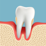 高齢者の歯周病　重度歯周病
